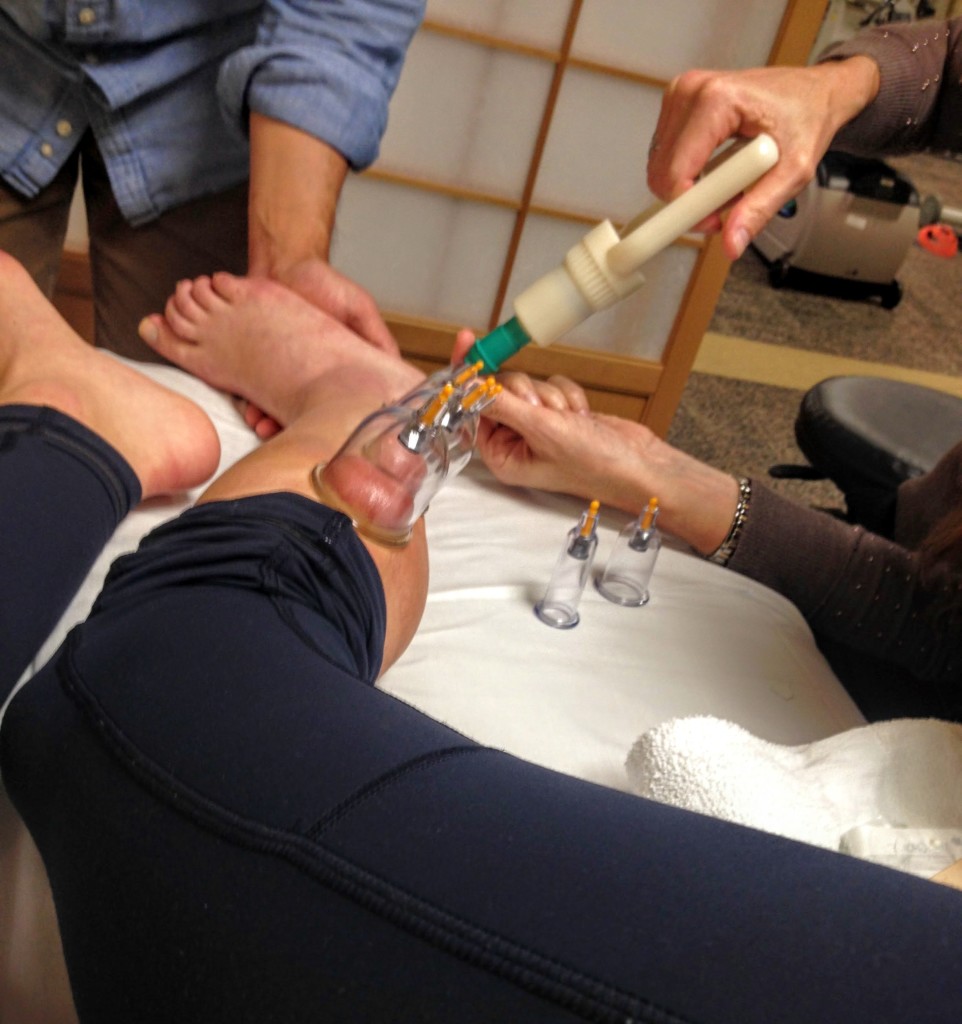 Benefits of Cupping for an Ankle Injury